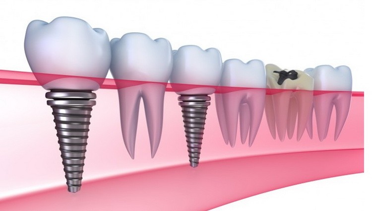 Zubni implanti kad se ugrade
