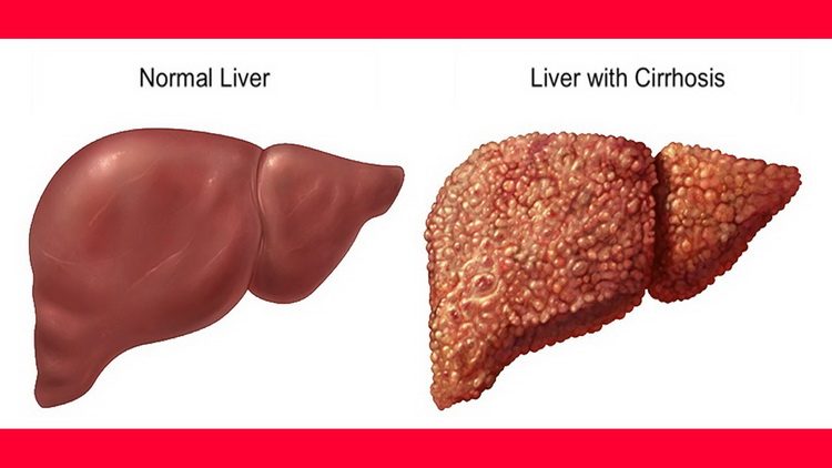 Zdrava i bolesna jetra - Šta je ciroza jetre i kako nastaje ciroza jetre