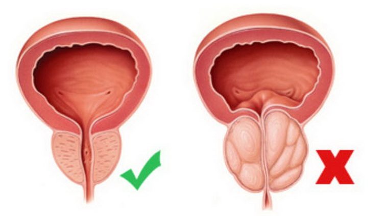 Uvećana prostata - Šta je Benigna hiperplazija prostate - uvećanje prostate