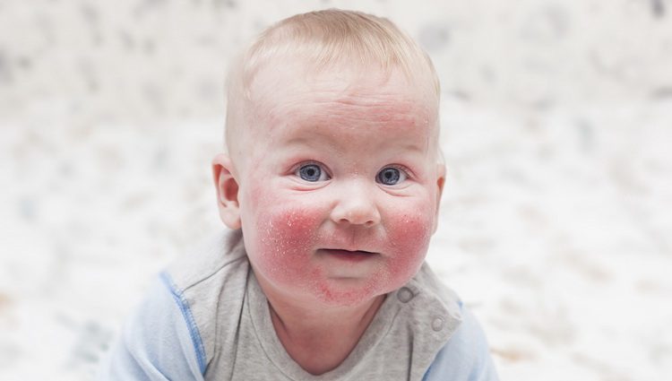 Ekcemi beba - Šta je atopijski dermatitis i kako se leči ekcem kože