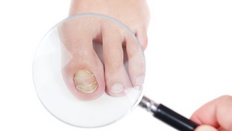Metode Kako izlečiti gljivice na noktima i gljivične infekcije