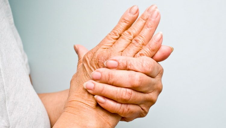 Šta je Psorijatični artirtis - kako su povezani Artritis i psorijaza
