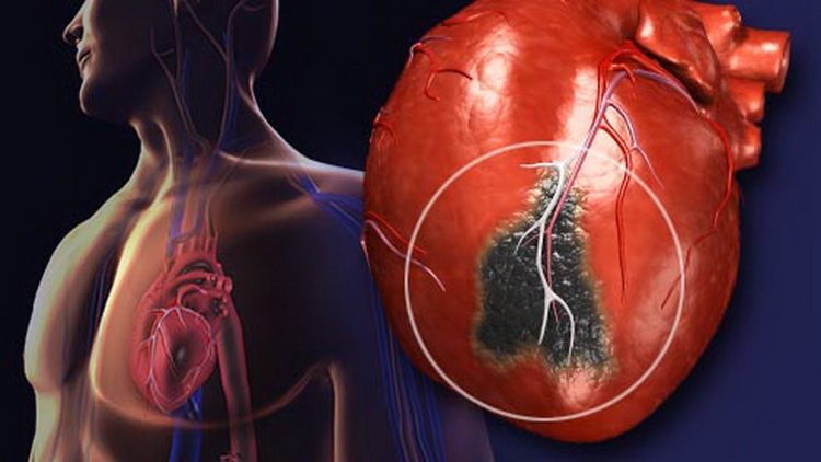 Šta je srčani infarkt udar infarkt miokard