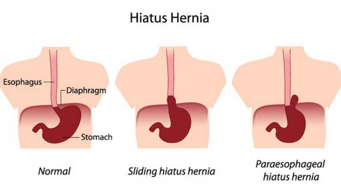 Želudačna kila i kako da spustite želudac – Vežbe za nameštanje želuca Hiatu hernia