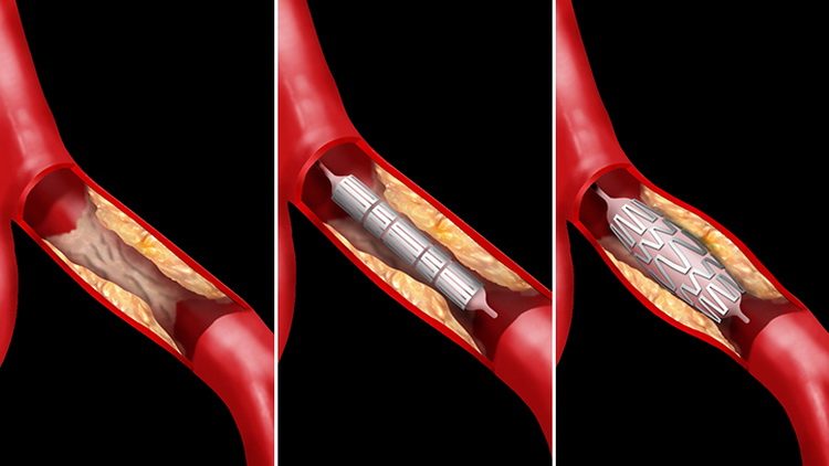 infarkt miokard i ugradjen stent - šta posle infarkta