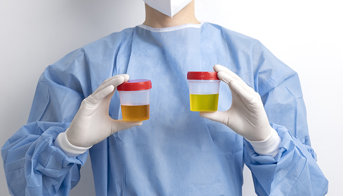 Boja i miris urina kao dijagnoza bolesti i stanja