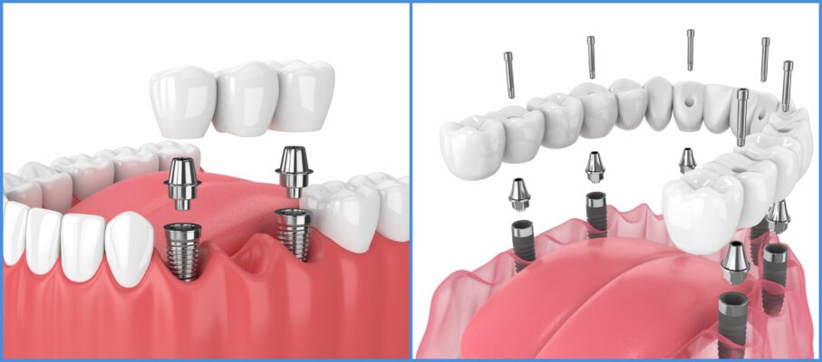 dentalni implantati